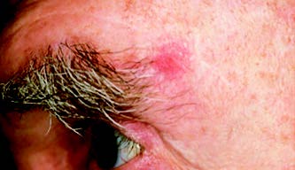 A reddish patch or irritated area
