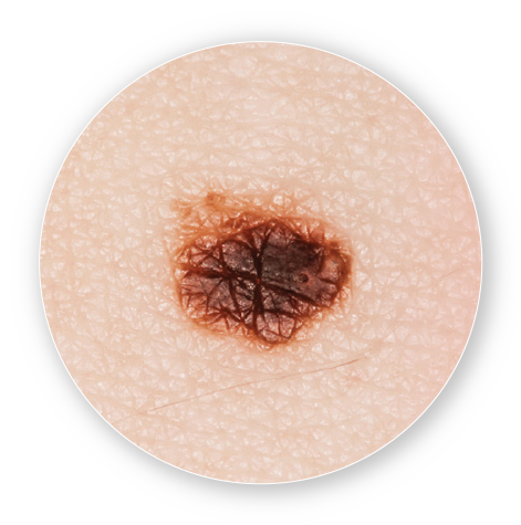 Basal Cell Carcinoma Patient Education Circle
