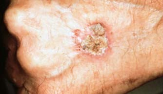 A persistent, scaly red patch with irregular borders that sometimes crusts or bleeds